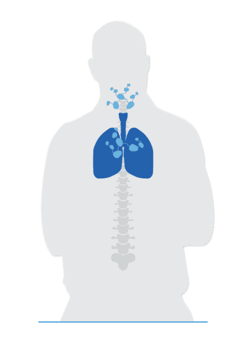 Diagram of David's lung and cancer spread visualized for metastatic non- small cell lung cancer (mNSCLC).