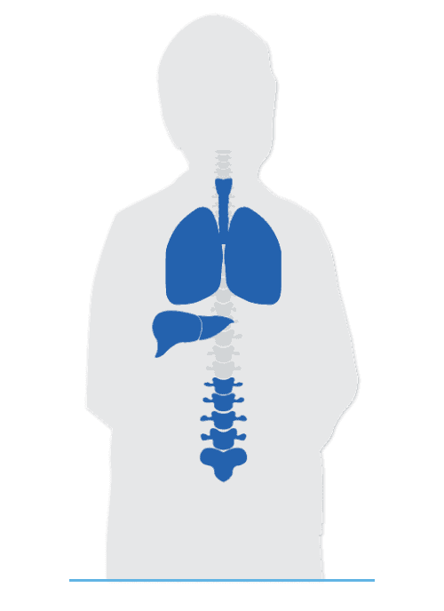 Diagram of Laura's lung and liver cancer spread visualized for metastatic non-small cell lung cancer.
