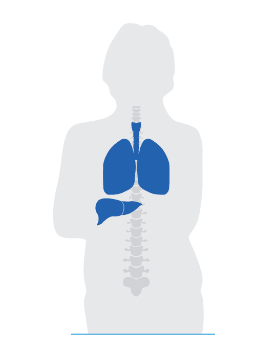 Diagram of Susan's lung and liver cancer spread visualized for metastatic non-small cell lung cancer.